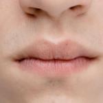 Naturalnie pełne policzki: przewodnik po bezpiecznych wypełnieniach stabilizowanym kwasem