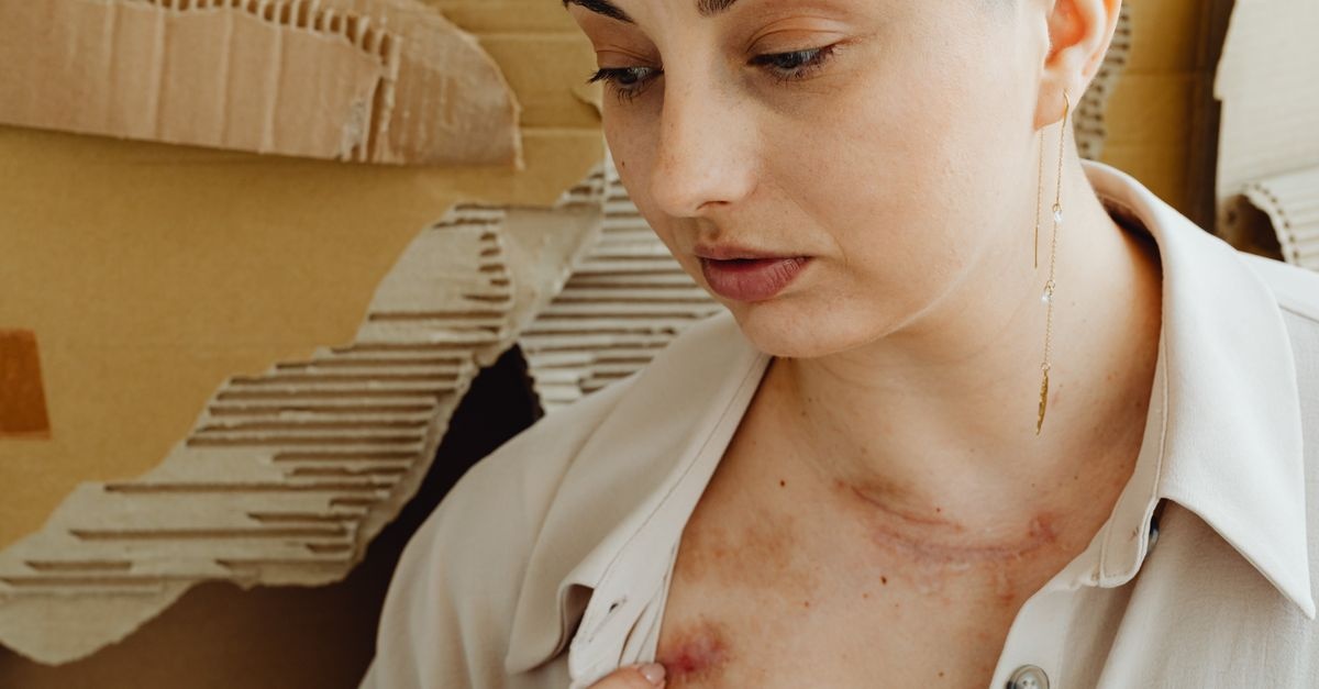 Piercing bez śladów: skuteczne i bezpieczne sposoby na blizny przerosłe oraz keloidy